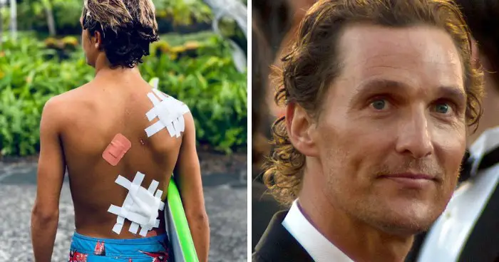 Matthew Mcconaughey Displays His Sons Serious Surf Injuries As Souvenirs