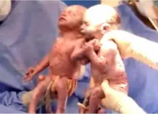 Doctor gasps seconds after delivering twins, looking down we see why!