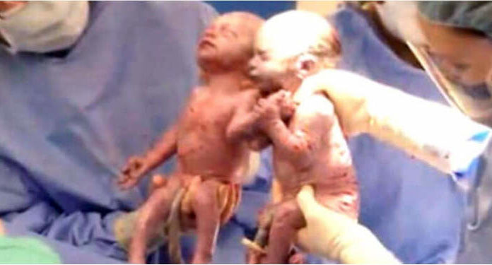 Doctor gasps seconds after delivering twins, looking down we see why!