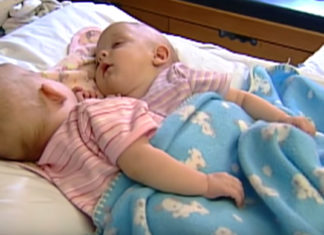 Conjoined twins were connected from birth, but surgery permanently changed everything