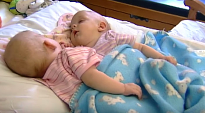 Conjoined twins were connected from birth, but surgery permanently changed everything