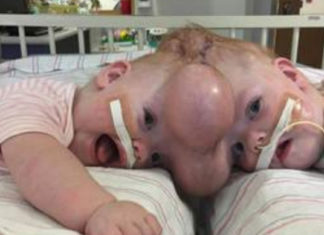 Conjoined twins Abby and Erin Delaney: Inside their remarkable story