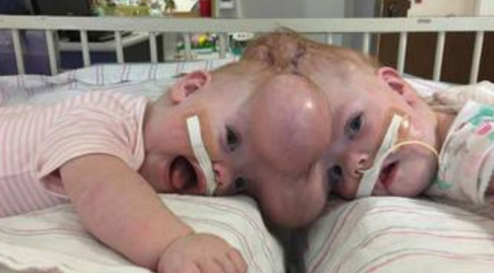 Conjoined twins Abby and Erin Delaney: Inside their remarkable story