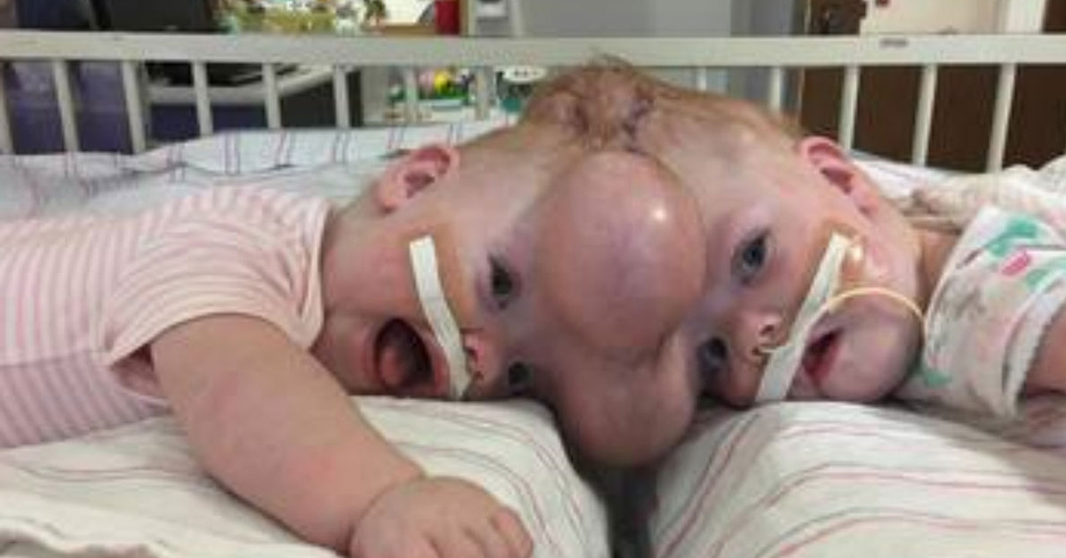 Conjoined Twins Are Finally Going Home To Sleep In Separate Beds After Risk...