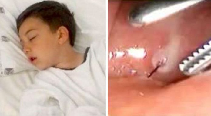 6-year-old almost dies from ingesting BBQ brush bristle while eating burger