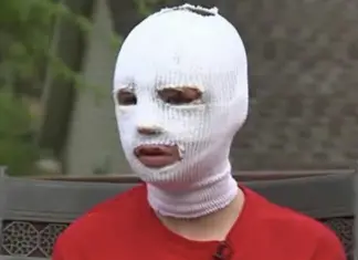 15-yr-old teen badly burnt in accident refuses to go to prom, sudden knock at door leaves her trembling