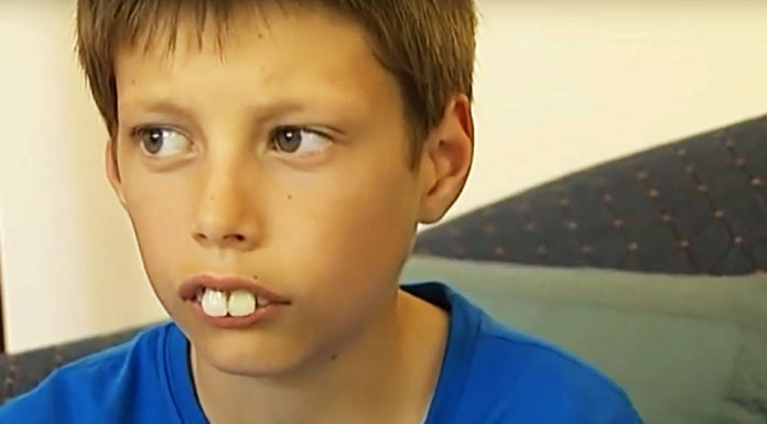 Boy called “rabbit” and bullied for his teeth gets incredible transformation