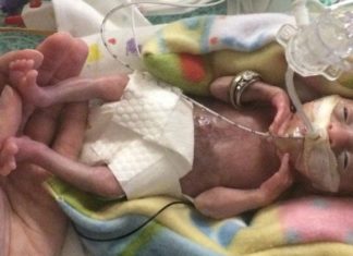 “Most Premature” Baby in the World is a Miracle
