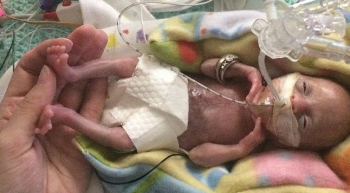 “Most Premature” Baby in the World is a Miracle