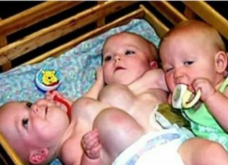 This ‘Unusual’ Set Of Conjoined Twins Was Born, But Take A Look At Them 16 Years Later