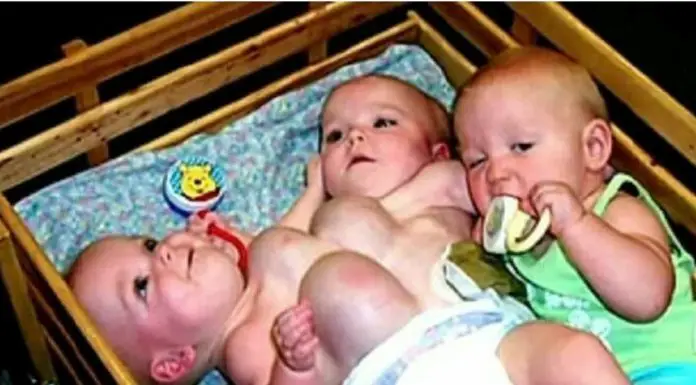 This ‘Unusual’ Set Of Conjoined Twins Was Born, But Take A Look At Them 16 Years Later