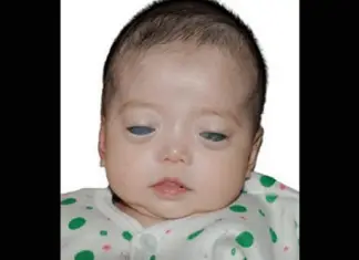Girl Born With Silver Eyes Finally Has Family That Loves Her