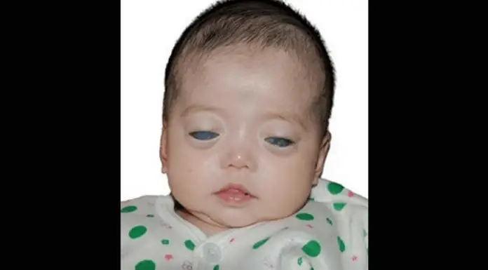 Girl Born With Silver Eyes Finally Has Family That Loves Her