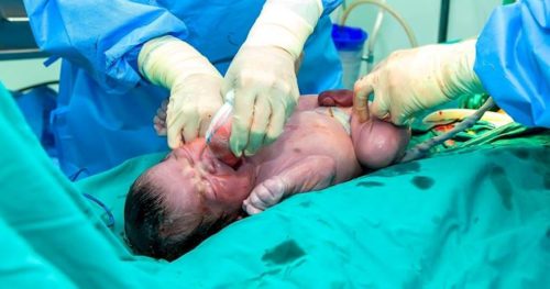 Miracle: Baby survives despite knot in his umbilical cord