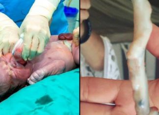 Miracle: Baby survives despite knot in his umbilical cord