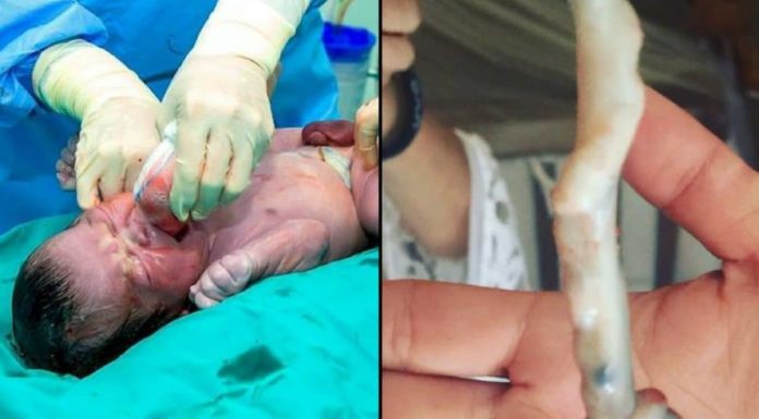 Miracle: Baby survives despite knot in his umbilical cord