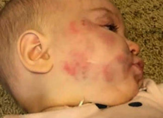 Mom goes to preschool to find baby has been bitten – camera reveals truth