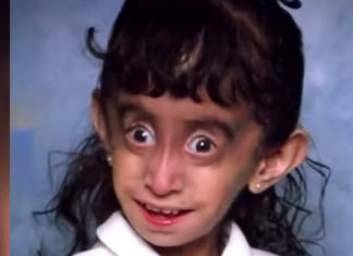 Lizzie was mocked for her looks her entire life, but she is fighting back with optimism