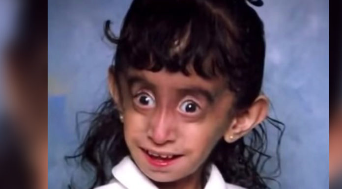 Lizzie was mocked for her looks her entire life, but she is fighting back with optimism