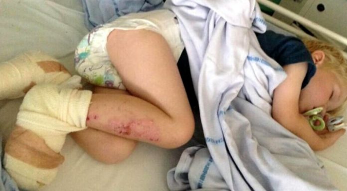 3-year-old comes screaming in pain: Now mom is spreading the word about the hidden dangers of the beach