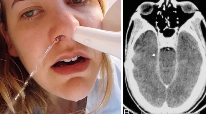 Seattle woman dies from rare amoeba after using neti pot