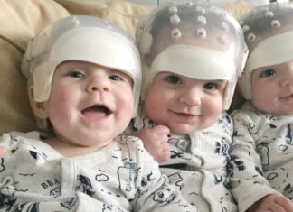 They’re the rarest triplets in the world: See what they look like today after historic surgery
