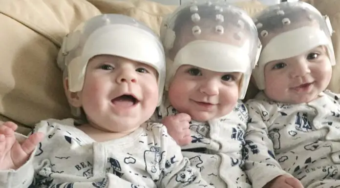 They’re the rarest triplets in the world: See what they look like today after historic surgery