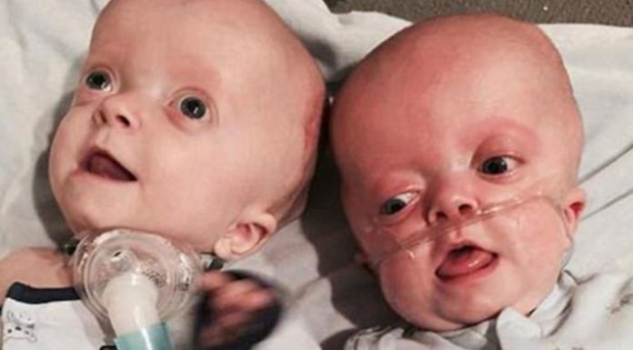 Nurse takes kids with Pfeiffer Syndrome home