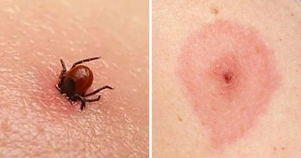 12-common-bug-bites-and-how-to-recognize-each-one