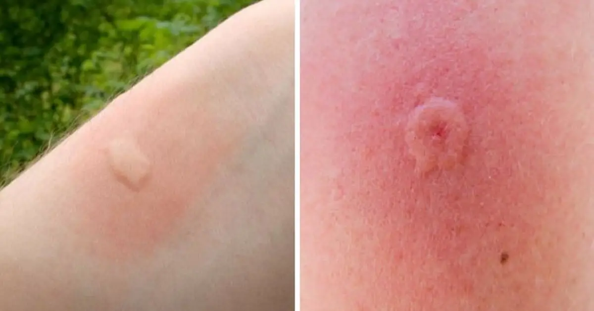 12-common-bug-bites-and-how-to-recognize-each-one