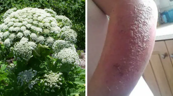 Plant Causes Severe Burns And Even Blindness And Is Now Spreading Quickly. Here’s What You Should Know