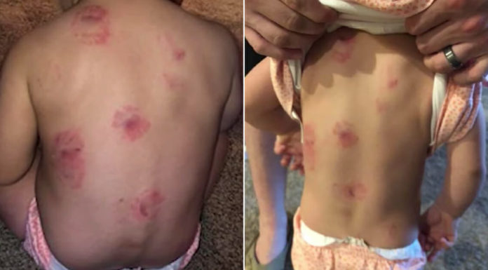 Parents demand answers after 1-yr-old toddler leaves day care covered in bloody marks
