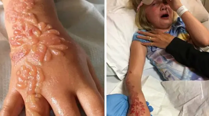 7-year-old girl left with severe burns after getting henna tattoo during vacation in Egypt