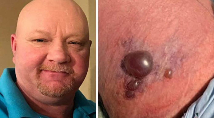 Man contracted flesh-eating bacteria during a kayaking trip and is now left fighting for his life