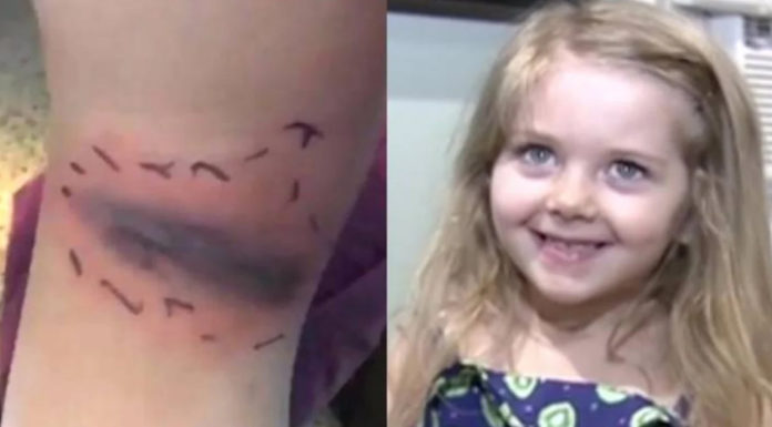 Mother spots bruise on daughter’s leg and thinks it’s harmless, but she’s wrong