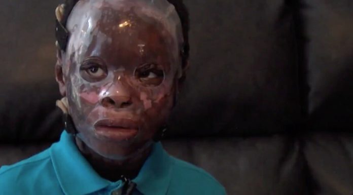 Strangers make offensive comments about 6-year-old boy who survived house fire