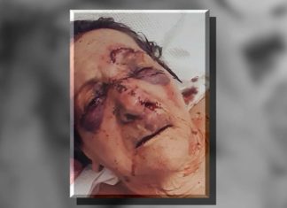 Assisted living facility under investigation after images of 86-year-old’s injuries surface