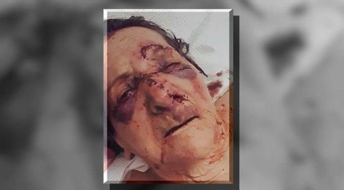 Assisted living facility under investigation after images of 86-year-old’s injuries surface