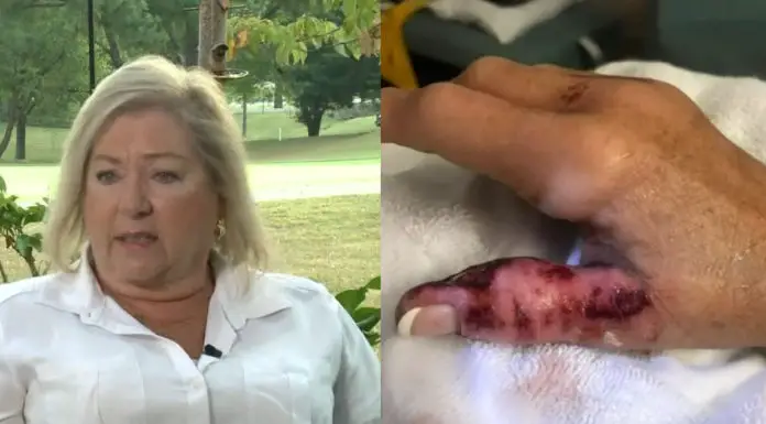 Woman has her nails done at a salon, contracts flesh-eating bacteria