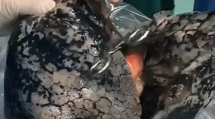 Millions were left in horror by blackened lungs of a life-long smoker