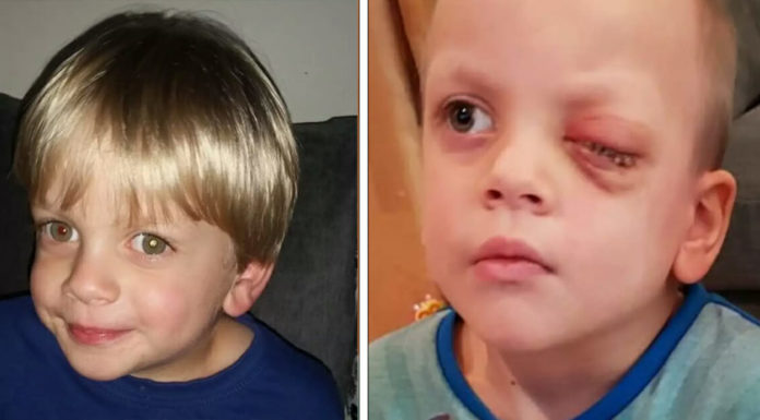 4-year-old boy has his eye removed over Christmas after mom spots rare cancer in photo