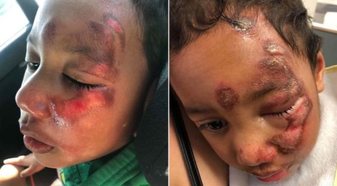 Disabled 4-year-old Boy Left With Severe Facial Injuries While At Daycare