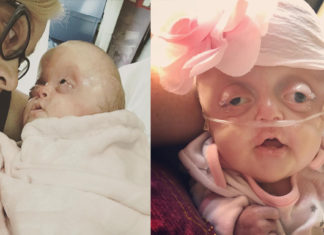 “Her eyes were huge, her skull was misshapen”: Mother describes the moment she first saw her baby daughter