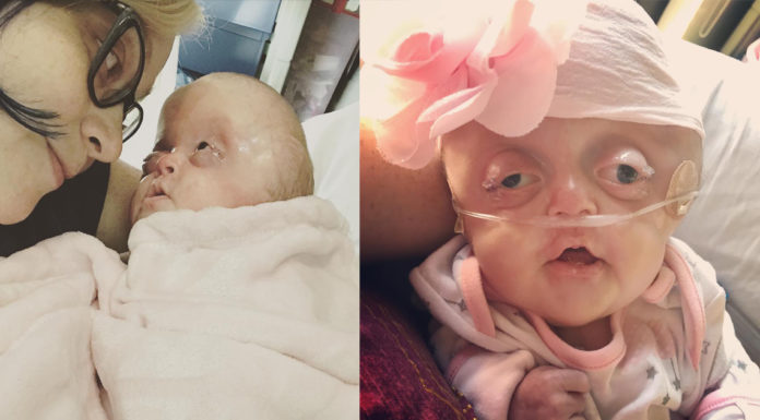“Her eyes were huge, her skull was misshapen”: Mother describes the moment she first saw her baby daughter