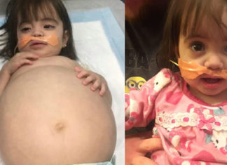 Little girl who looked 8 months’ pregnant because of deadly disease is saved thanks to dad’s kidney donation