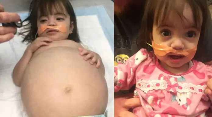 Little girl who looked 8 months’ pregnant because of deadly disease is saved thanks to dad’s kidney donation