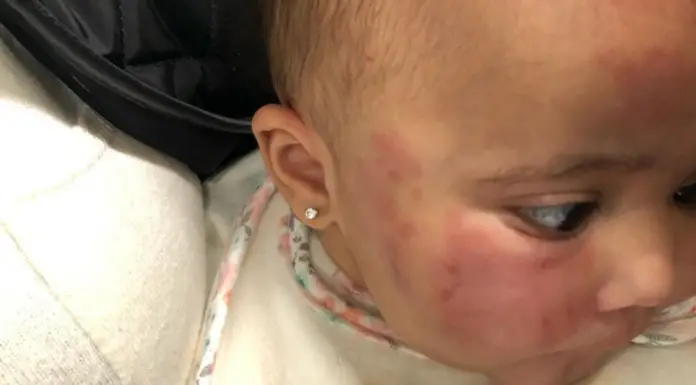 Mom Picks 6-month-old Baby Daughter Up at Daycare to Discover Her Whole Body is Covered in Bites and Bruises