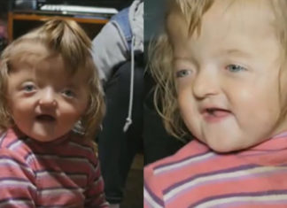 Girl with deformity banned from Pre-K by owners because she “will scare other kids”