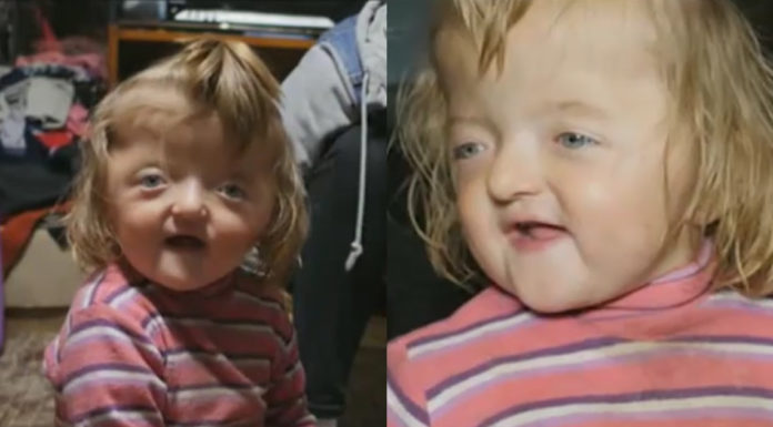 Girl with deformity banned from Pre-K by owners because she “will scare other kids”