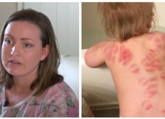 25 bloody bite marks all over baby’s body: Mom’s horrific discovery after picking her girl up from daycare